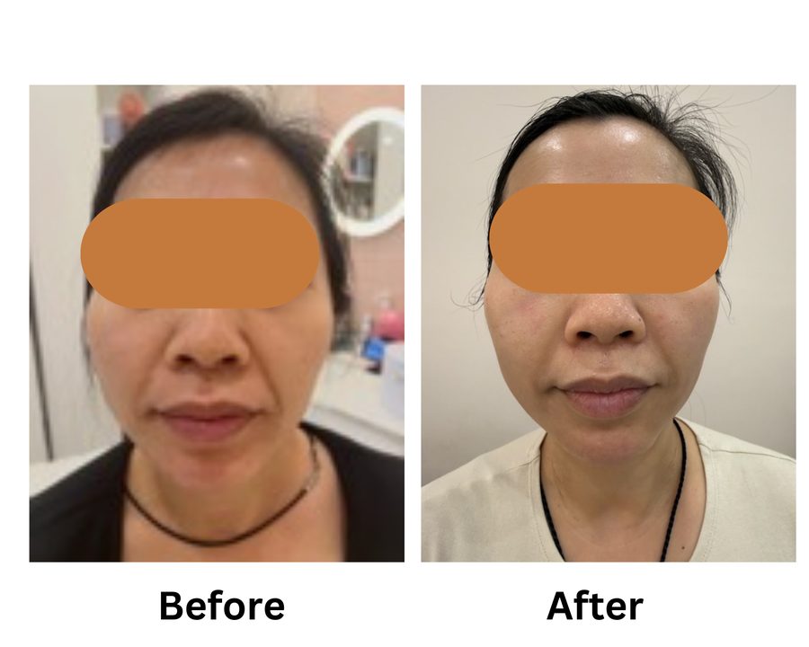 HIFU face treatment before and after result