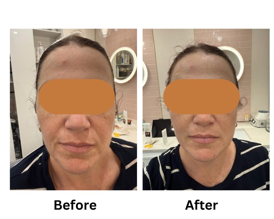 HIFU treatment before and after skin improvement